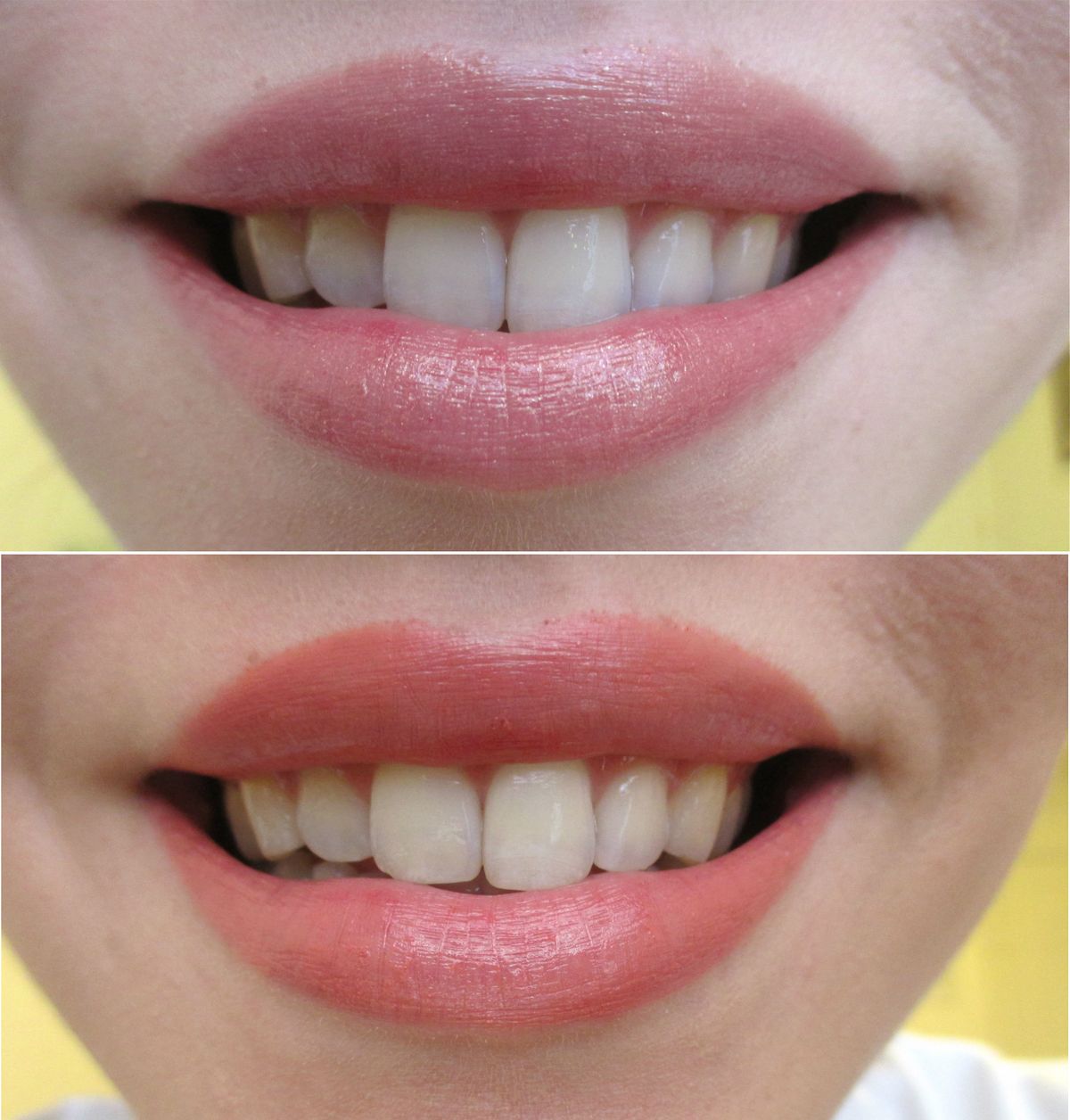 Noord West Verbaasd Allergie Welke kleur lippenstift zorgt ervoor dat de tanden er witter uitzien? Een  handige gids om direct uw meest briljante glimlach te krijgen - Mode