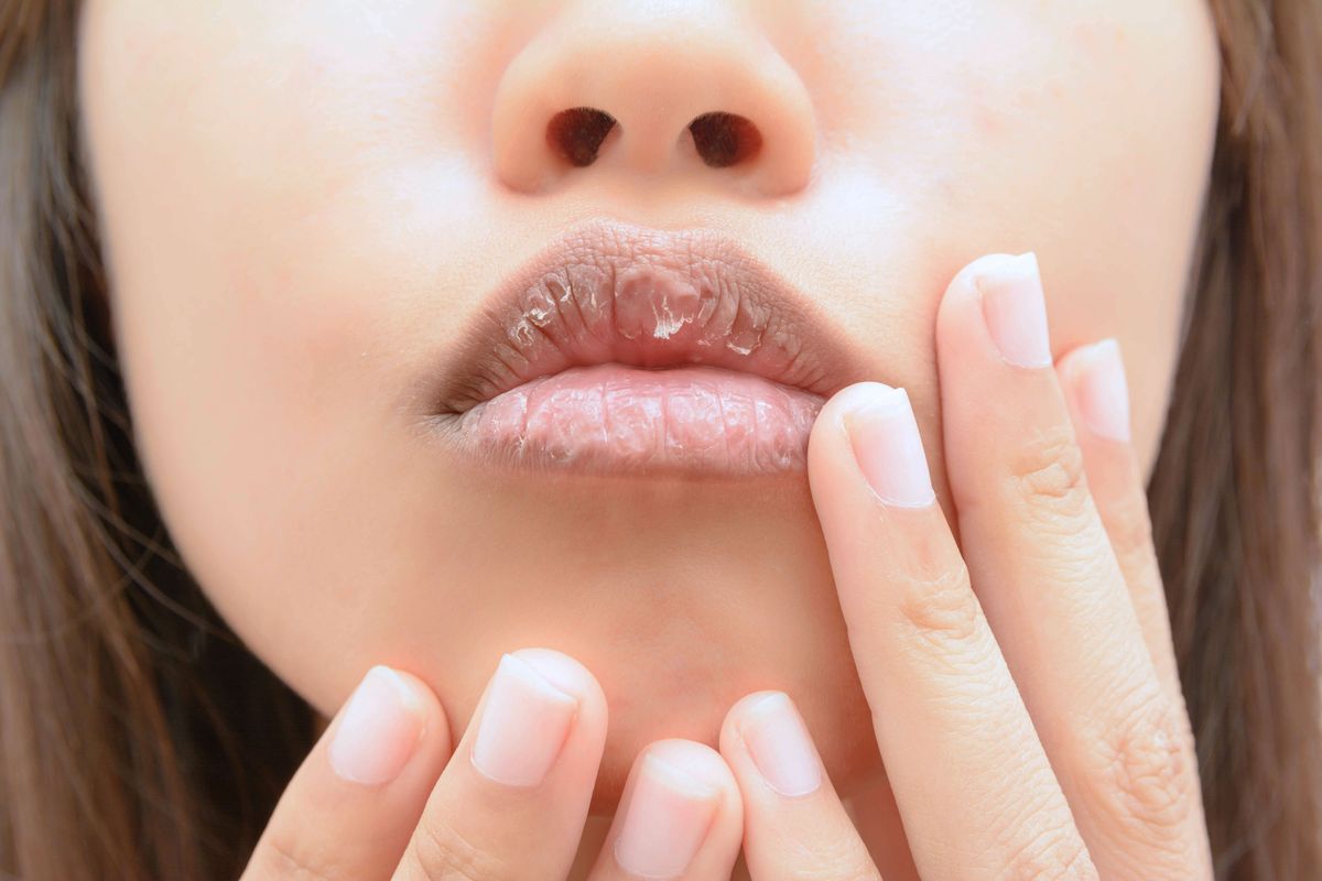 6 asiaa, joita huulet voivat kertoa terveydestäsi